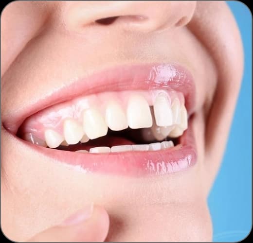 Diastema (Ayrık Diş) Tedavisi