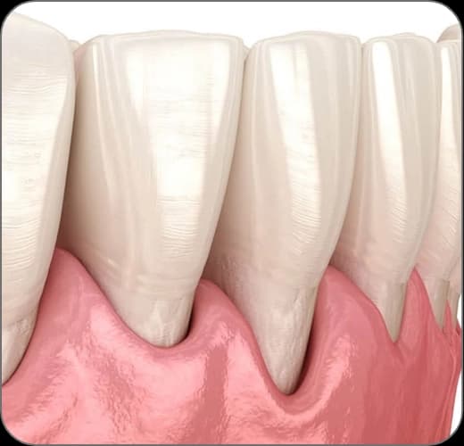 Diş Eti Çekilmesi (Periodontitis)