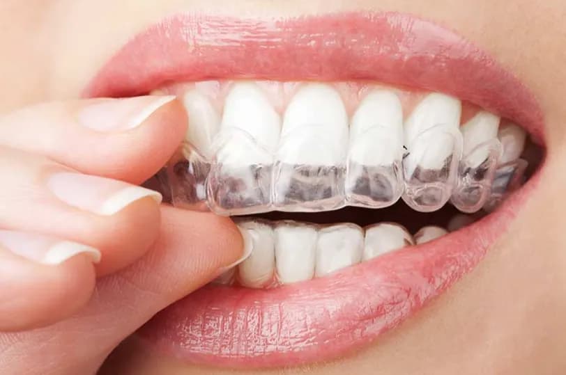 Invisalign (Şeffaf Plak)